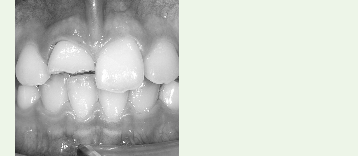 Zahnunfall 1